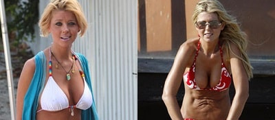 A picture of Tara Reid before (left) and after (right).
